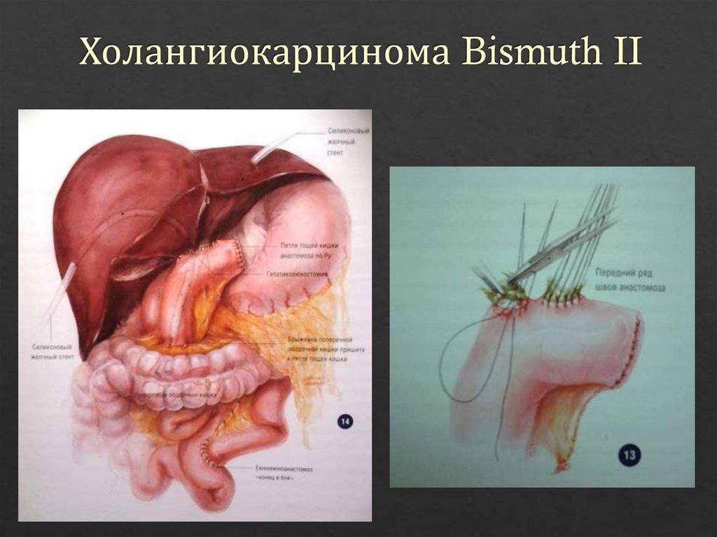 Холангиокарцинома Bismuth II
