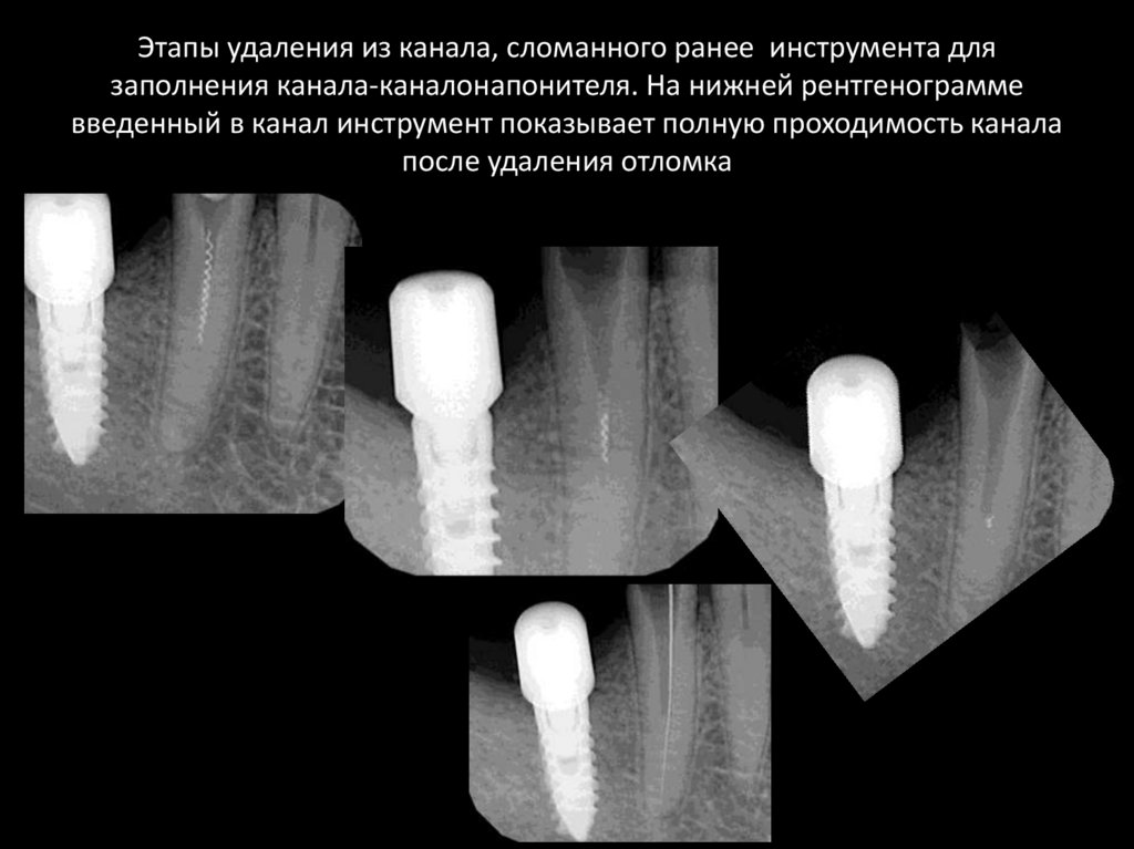Пломбирование корневых каналов зуба - презентация онлайн