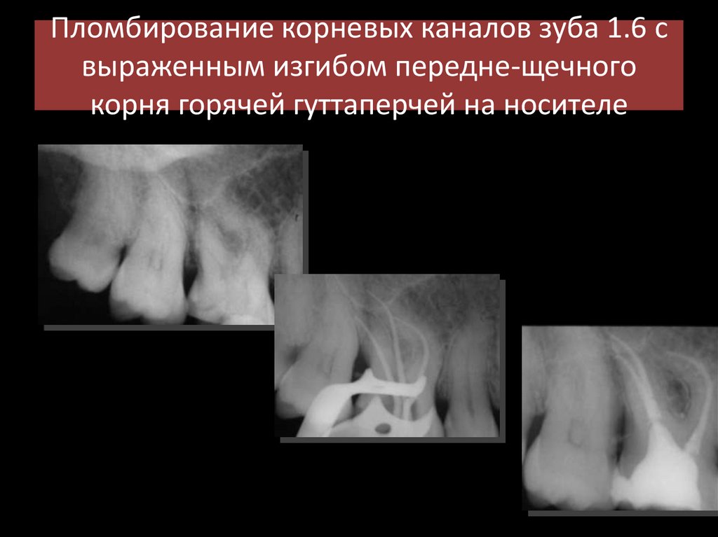 Пломбирование корневых каналов зуба - презентация онлайн