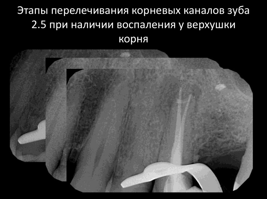 Пломбирование корневых каналов зуба - презентация онлайн