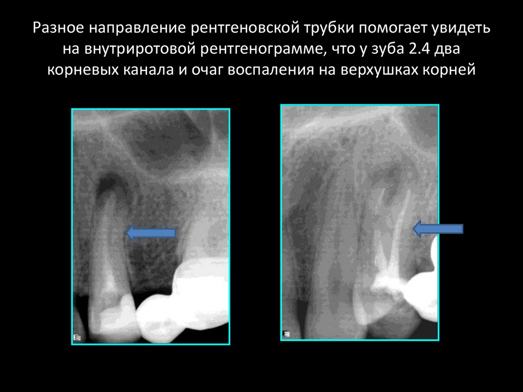 Пломбирование корневых каналов зуба - презентация онлайн