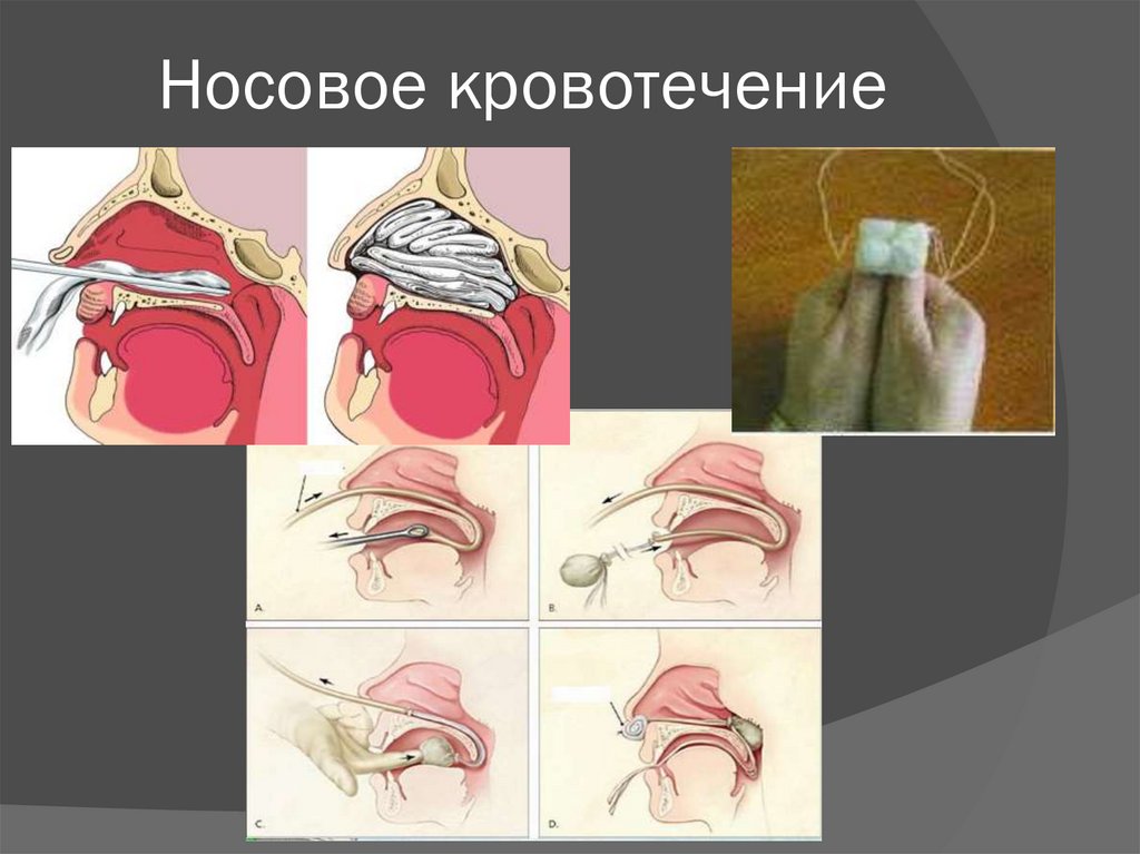 Носовое кровотечение