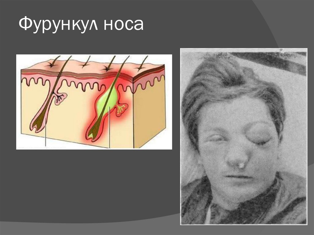 Фурункул носа