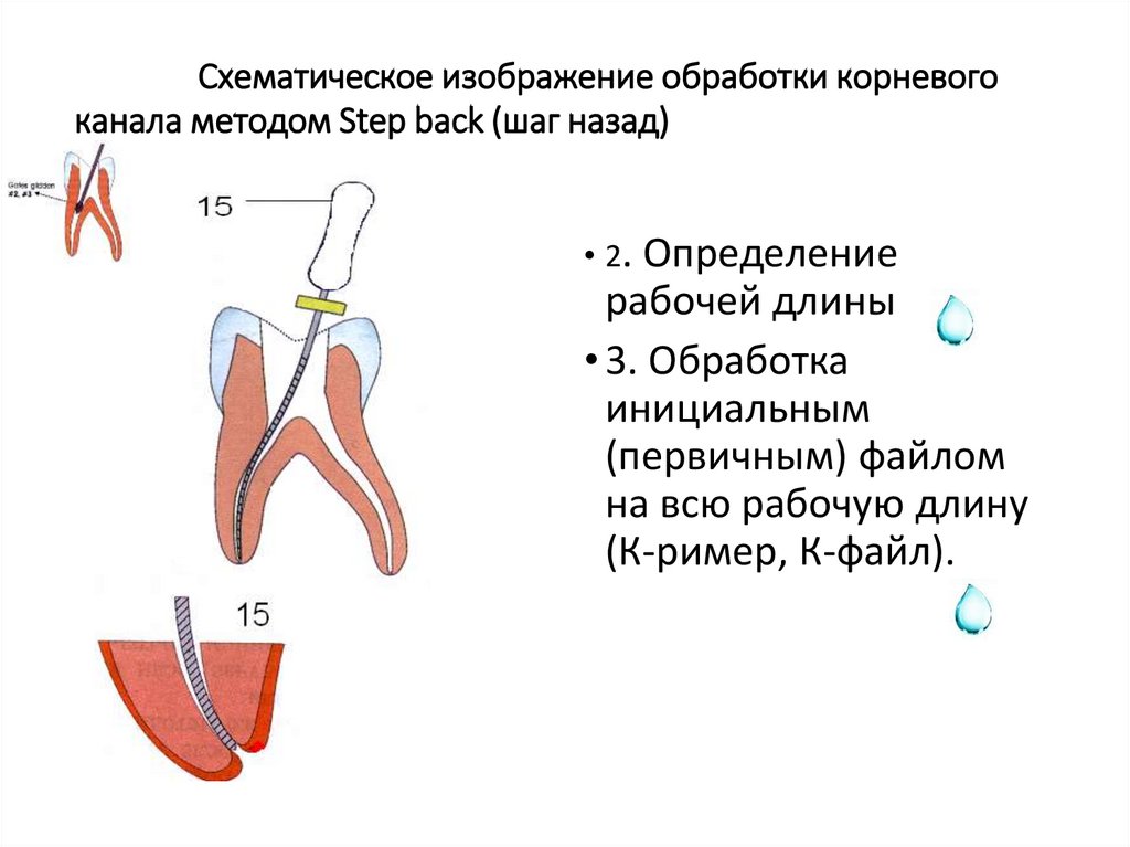 Обработка каналов файлами. Стандартный метод обработки корневых каналов. Алгоритм медикаментозной обработки корневого канала. Инструментальная обработка корневых каналов при периодонтите. Этапы обработки корневых каналов.