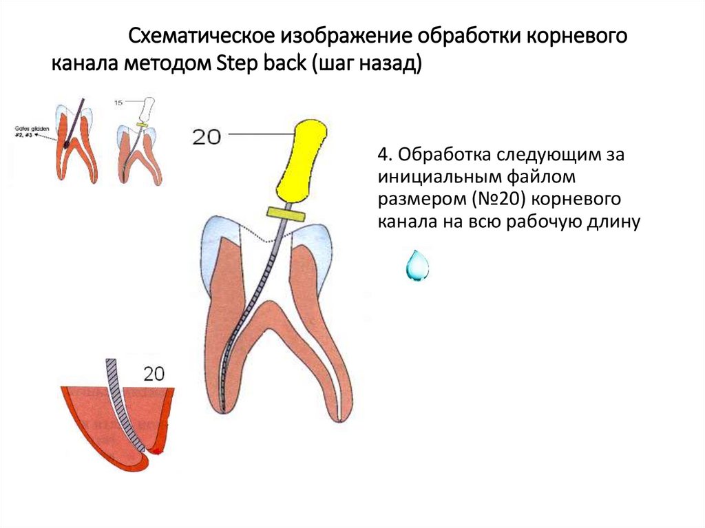 Обработка каналов файлами. Степ бэк обработка корневых каналов. Протокол мед обработки корневых каналов. Апикально корональные методы обработки корневых. Алгоритм обработки корневого канала.