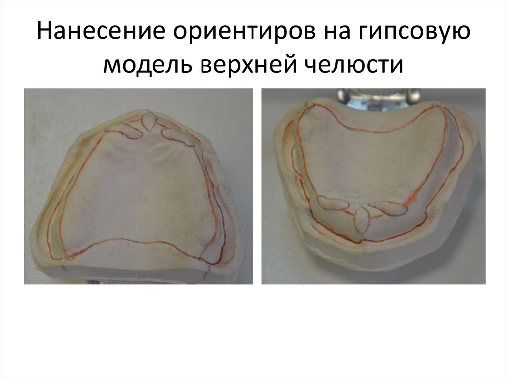 Нанесение ориентиров на гипсовую модель верхней челюсти