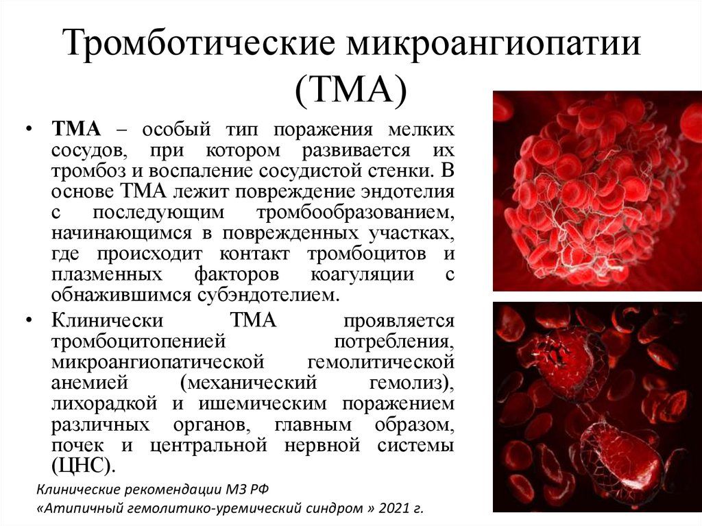 Микроангиопатия головного мозга