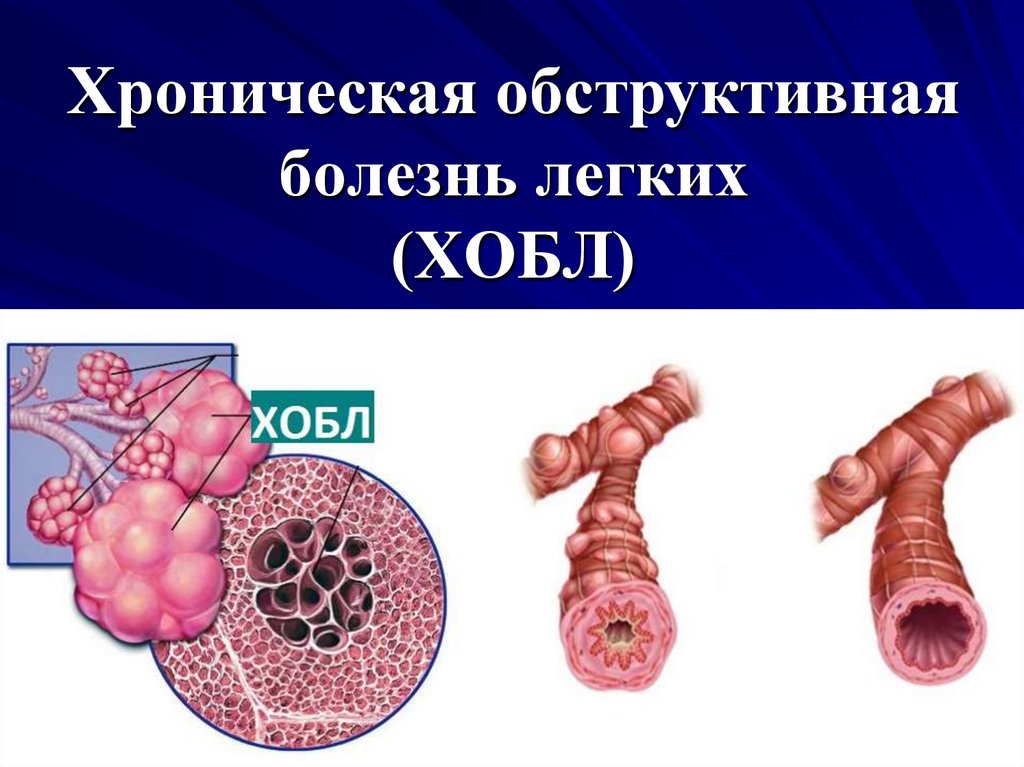 Хроническое обструктивное заболевание. Обструктивная болезнь лёгких (ХОБЛ). Хроническая обструктивная болезнь легких.