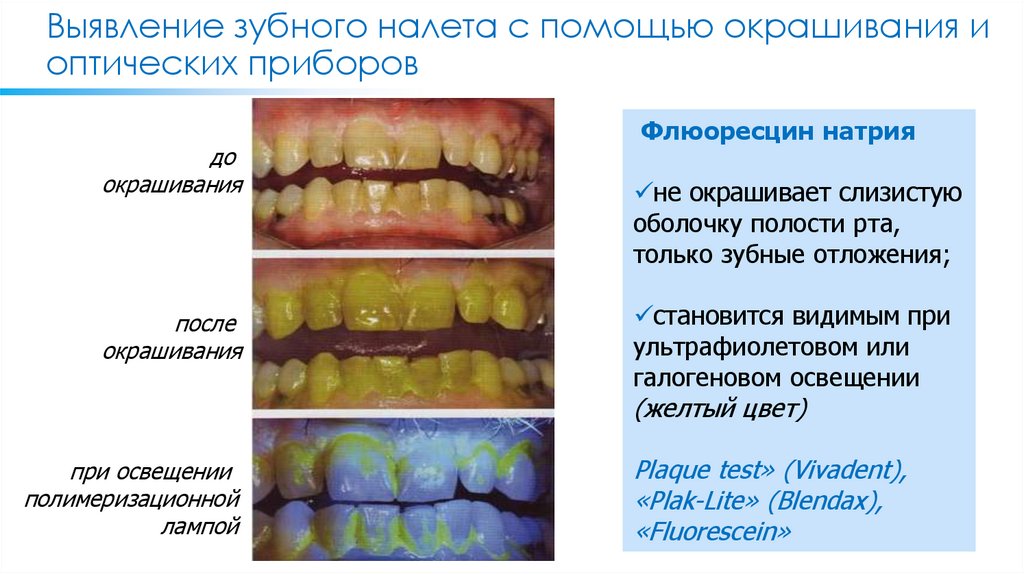 Оценка состояния полости рта. Методика выявления зубных отложений. Обнаружение зубного налета. Метод выявление зубного камня.
