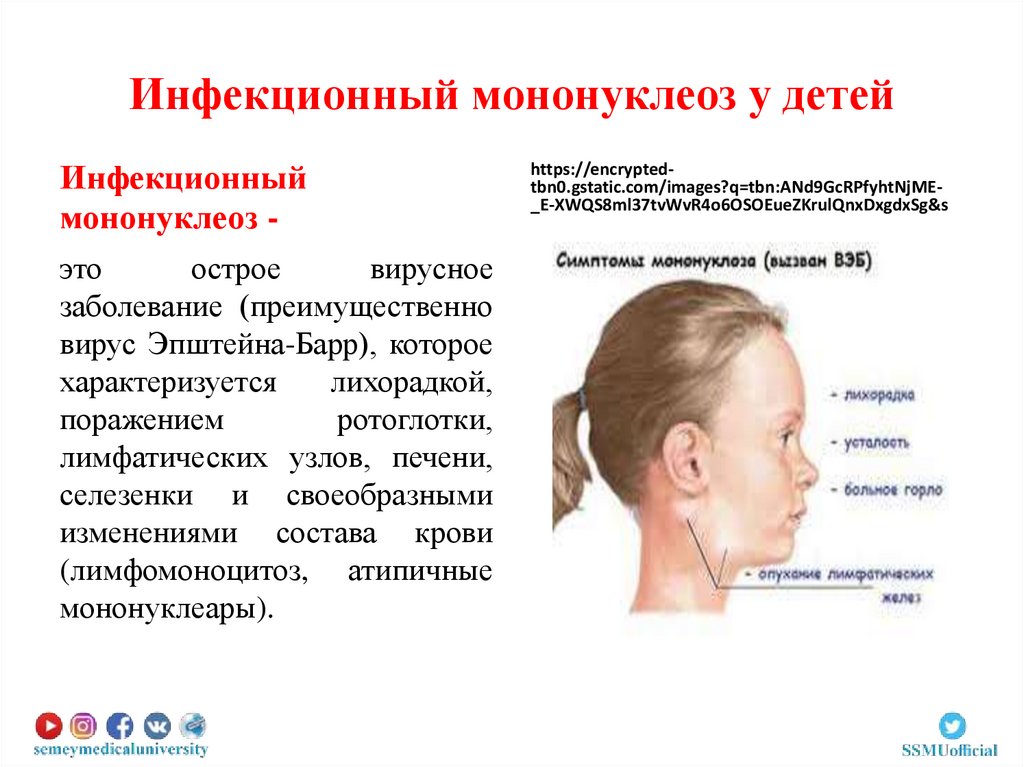 Инфекционный мононуклеоз у детей последствия