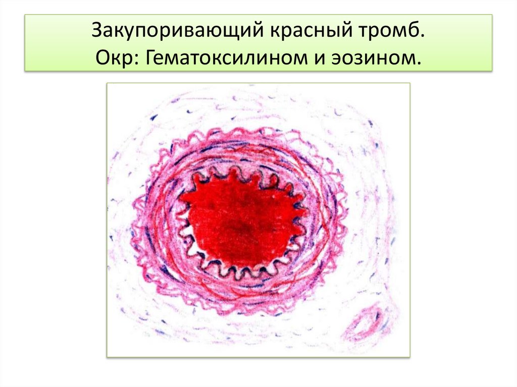 Строение тромба. Красный тромб патологическая анатомия.