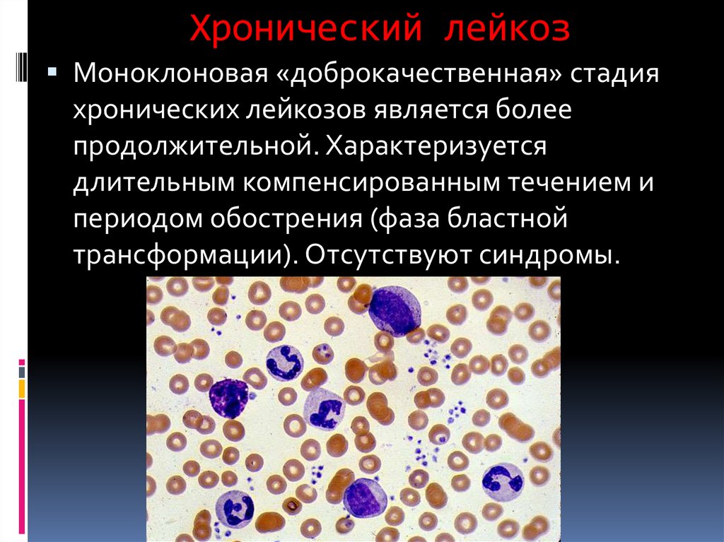 Лейкоз характеризуется. Хронический лейкоз. Моноклоновая стадия лейкоза. Хронический гемобластоз. Хронический мегакариоцитарный лейкоз.