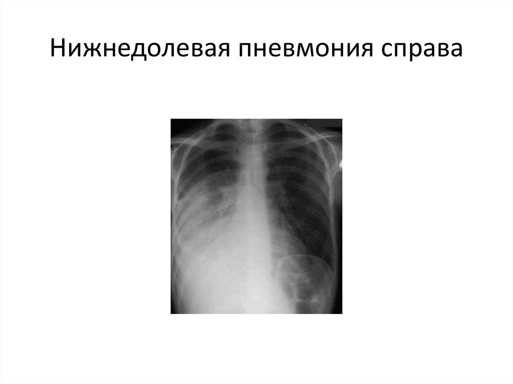 Пневмония в правом легком в нижней доле. Нижнедолевая пневмония справа рентген. Внебольничная правосторонняя пневмония. Пневмония правосторонняя нижнедолевая снимок. Внебольничная правосторонняя нижнедолевая пневмония.