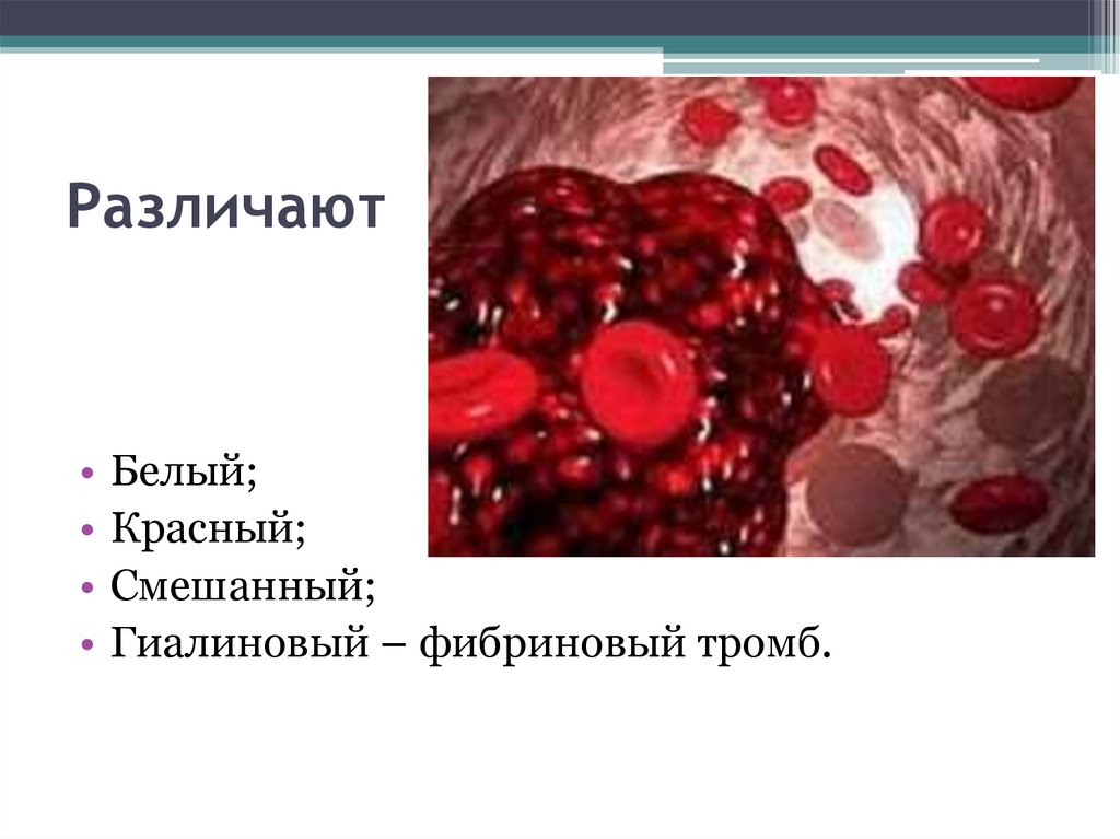 Ишемия крови. Фибриновый и гиалиновый тромбы. Ишемия стаз тромбоз и эмболия. Белый красный смешанный гиалиновый тромб.