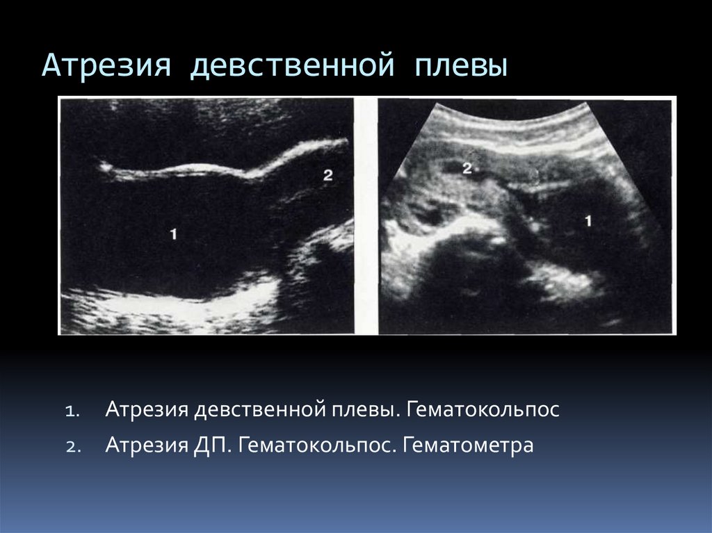 Где находится девственная плева. Атрезия девственной плевы. Атрезия девственной плевы фото.