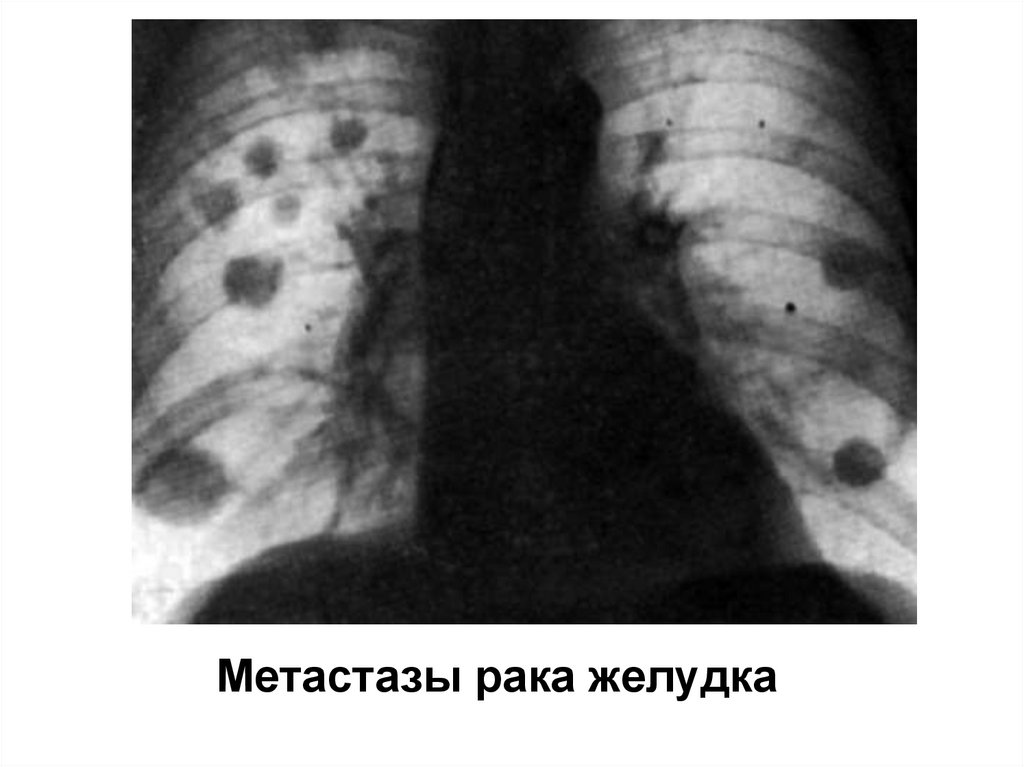 Черные точки на легких. Рентген туберкулез туберкулема. Туберкулома туберкулез рентген. Туберкулема патологическая анатомия. Туберкулез рентгенологические снимки.