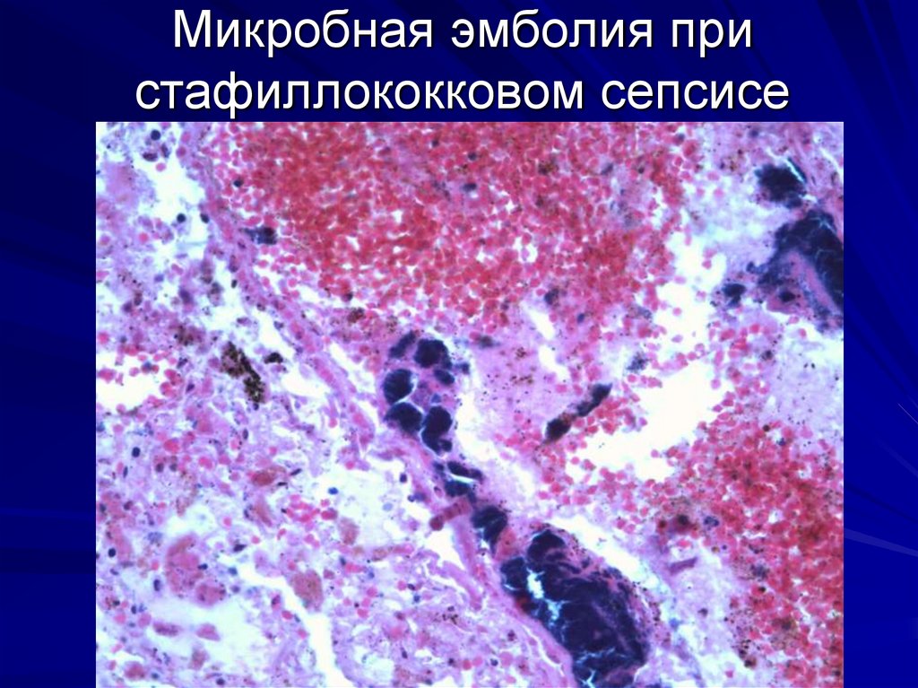 Гиперплазия селезенки. Септический очаг это патанатомия. Сепсис патологическая анатомия микропрепараты. Септическая селезенка патанатомия.