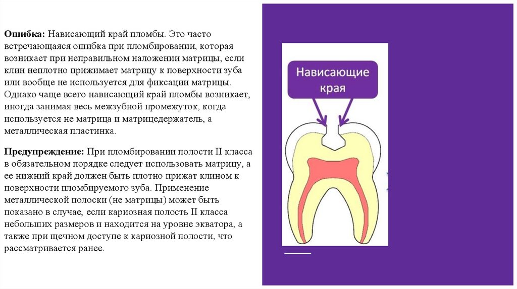 Ошибки и осложнения при диагностике и лечении кариеса презентация