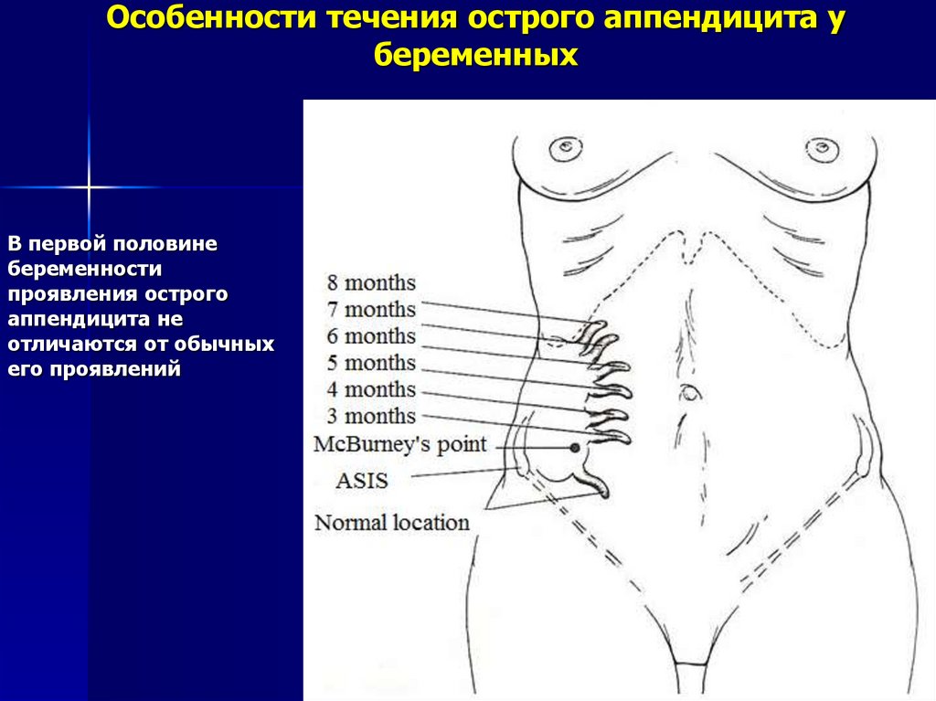 Презентация аппендицит и беременность