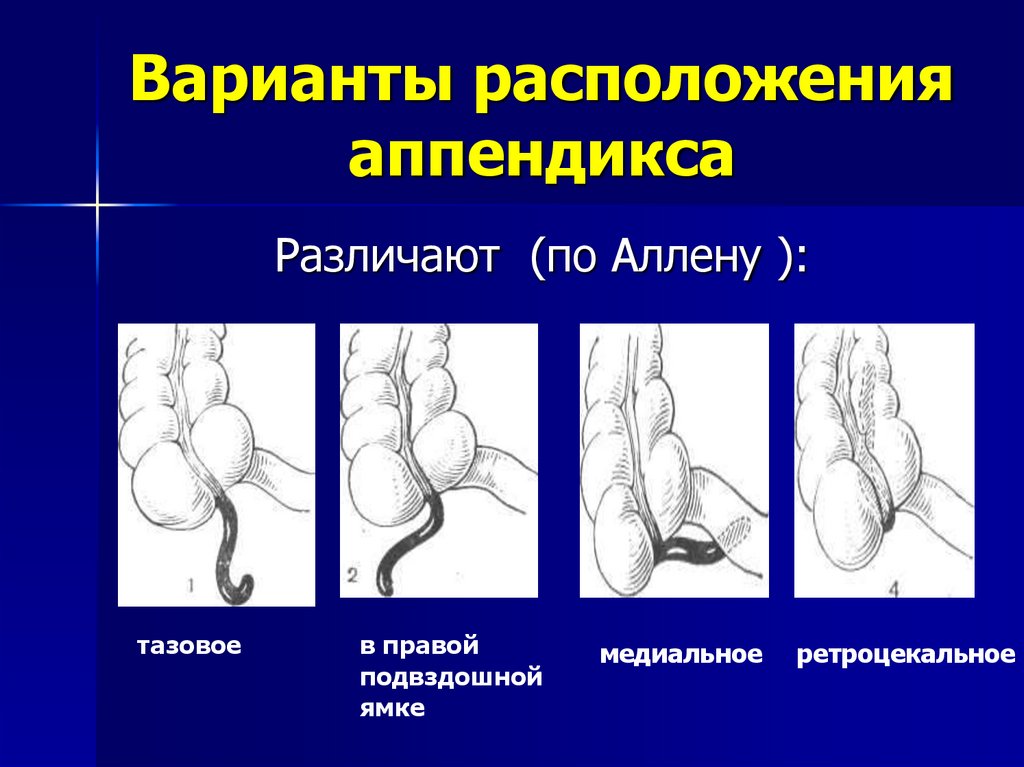 Расположение аппендицита. Ретроперитонеальное расположение аппендикса. Тазовое расположение аппендицита. Ретроцекальное расположение аппендикса симптомы.