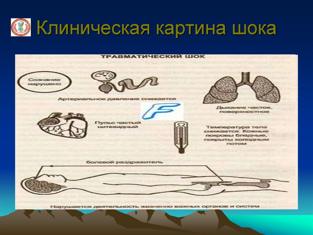 Клиническая картина шока