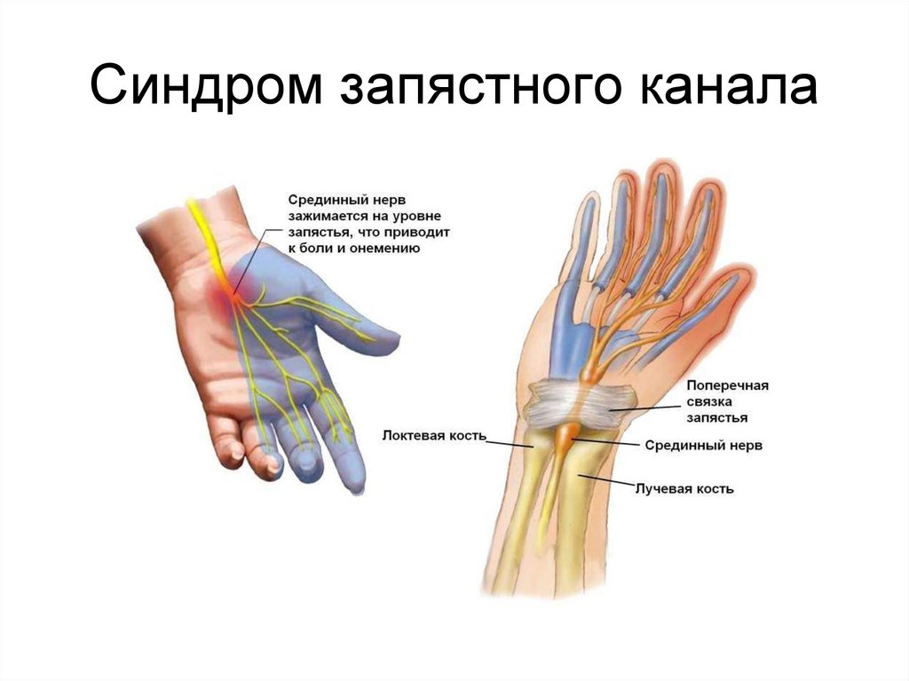 Нейропатия карпального канала. Туннельный карпальный синдром руки. Карпальный (кистевой) туннельный синдром. Туннельный синдром срединного нерва. Карпальный канал лучезапястного сустава.