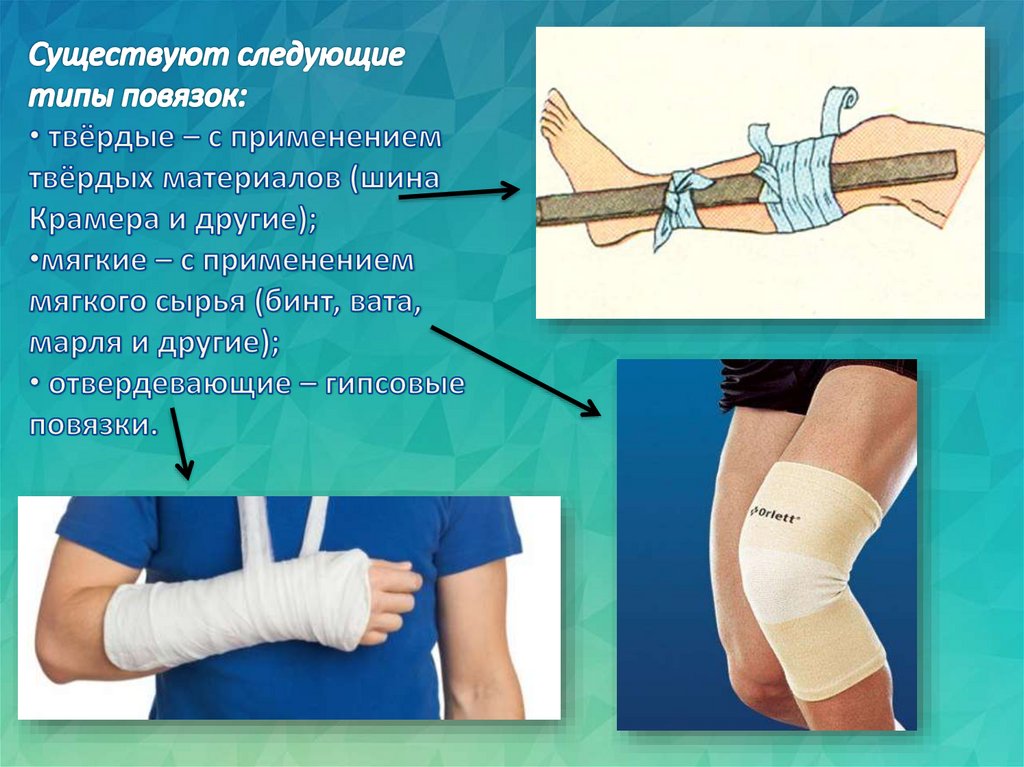 Мягкие повязки презентация