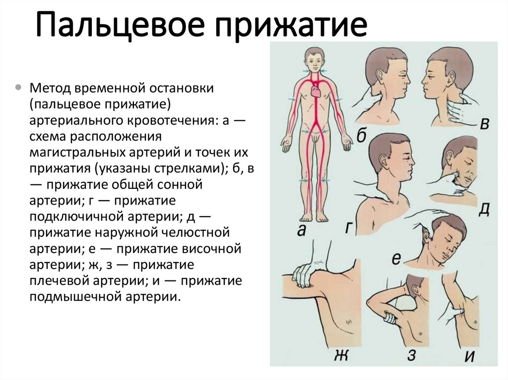 Пальцевое прижатие артерий. Пальцевое прижатие артерий при кровотечениях. Пальцевое прижатие подключичной артерии. Точки прижатия артерий для остановки кровотечения.