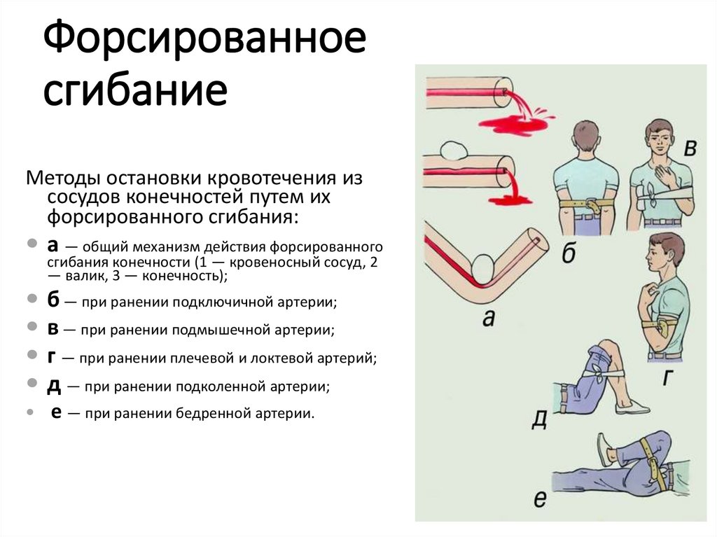 Максимальное сгибание конечности в суставе. Форсированное сгибание. Форсированное сгибание. Форсирование сгибания конечности. Остановка кровотечения из сосуда.
