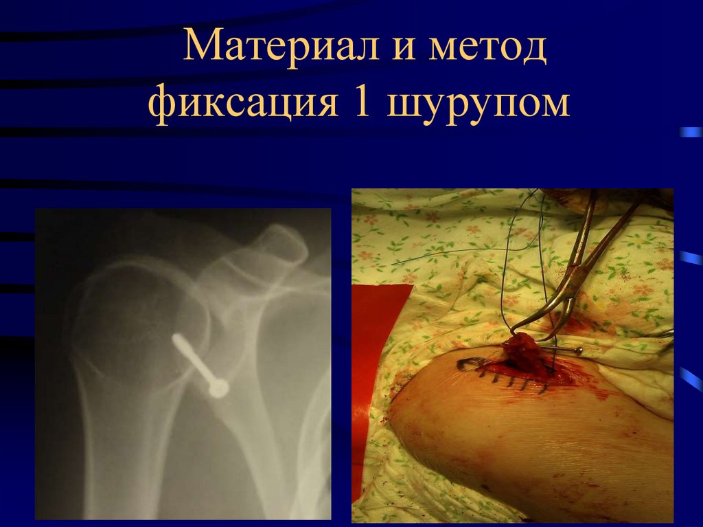 Материал и метод фиксация 1 шурупом