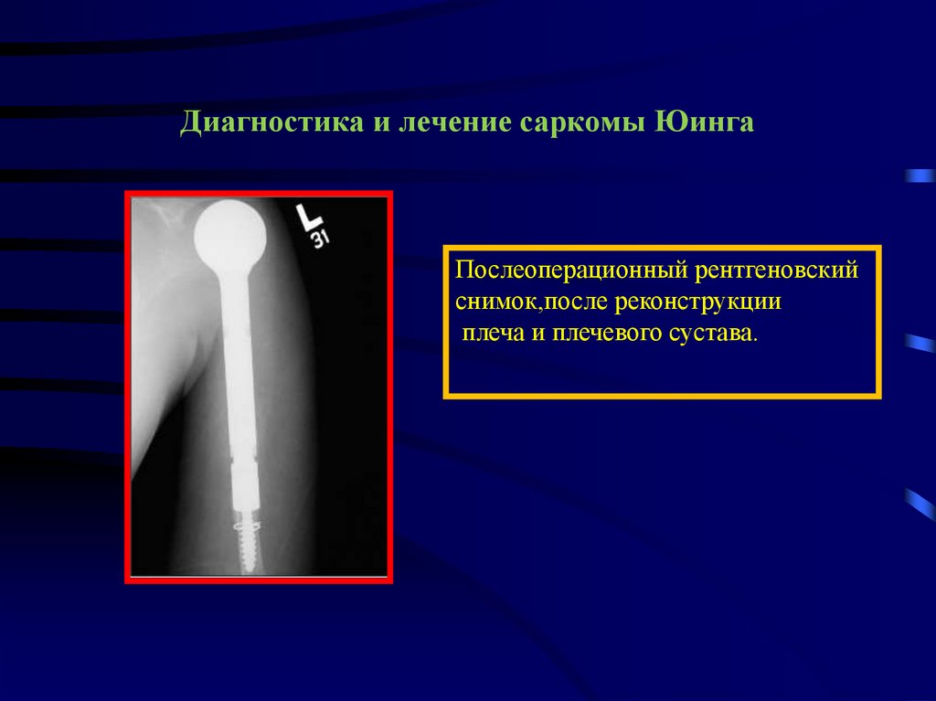 Лечу саркому. Саркома Юинга плечевой кости рентген. Саркома Юинга опухоль костей.