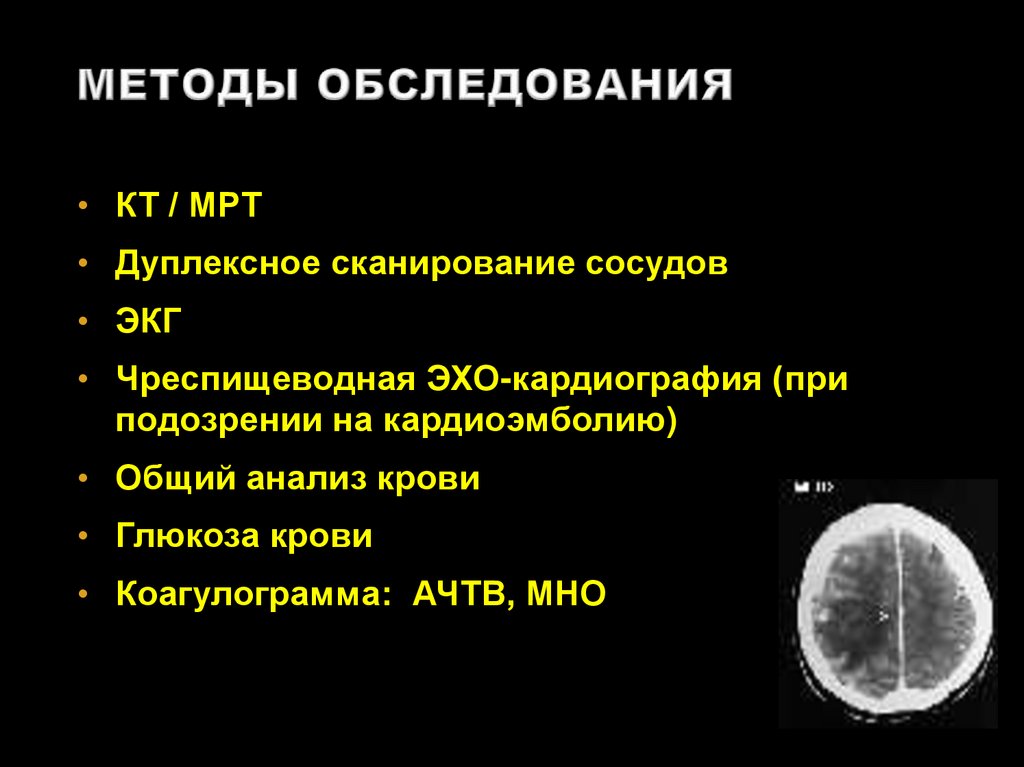 Инсульты и преходящие НМК - презентация онлайн