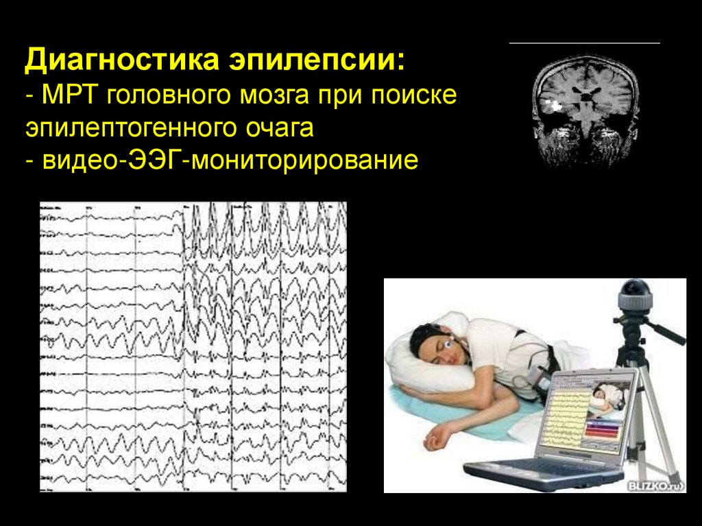Инсульты и преходящие НМК - презентация онлайн