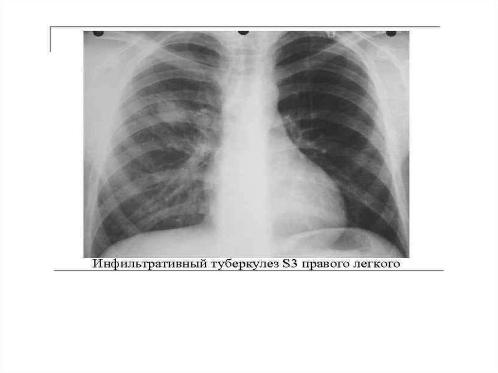 Инфильтрация это. Инфильтративный туберкулез легких рентген. Инфильтративный туберкулёз лёгких рентген. Инфильтративный туберкулез в фазе распада рентген. Инфильтративный туберкулез s6 правого легкого фаза распада.