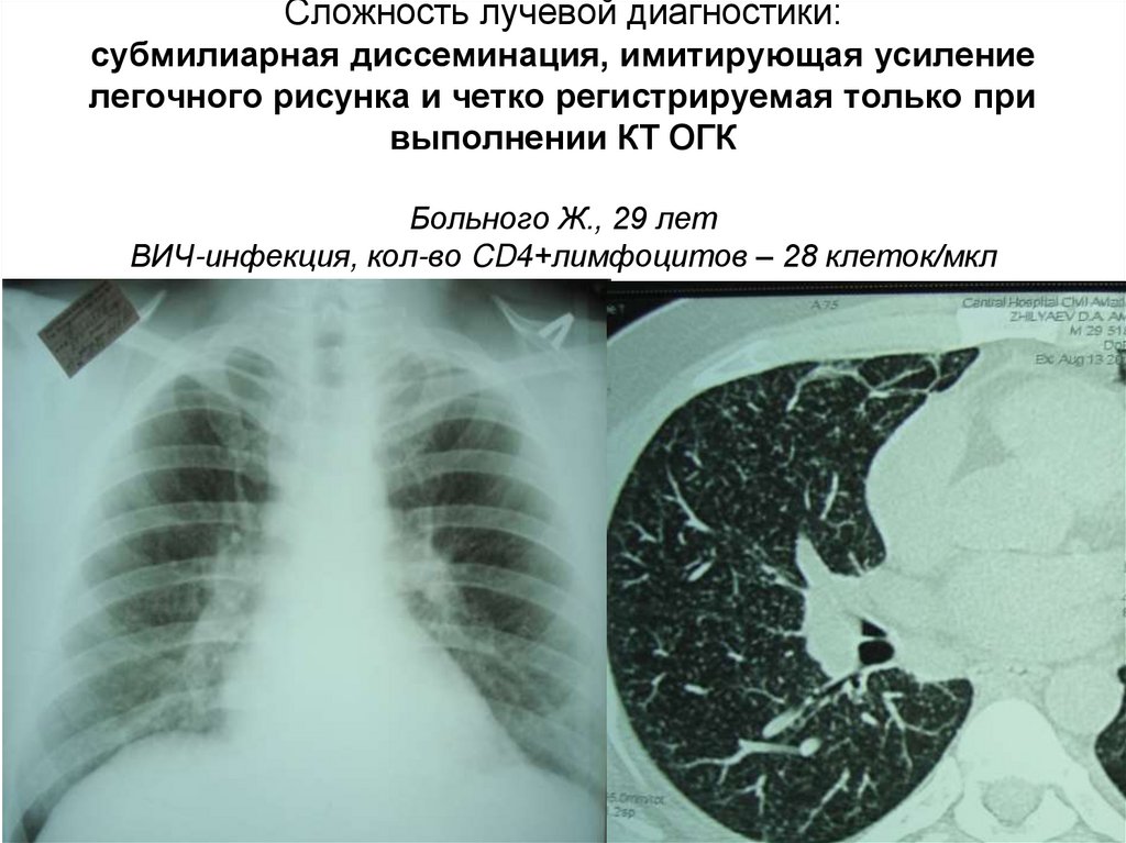 Усилен легочный рисунок в прикорневых зонах что это