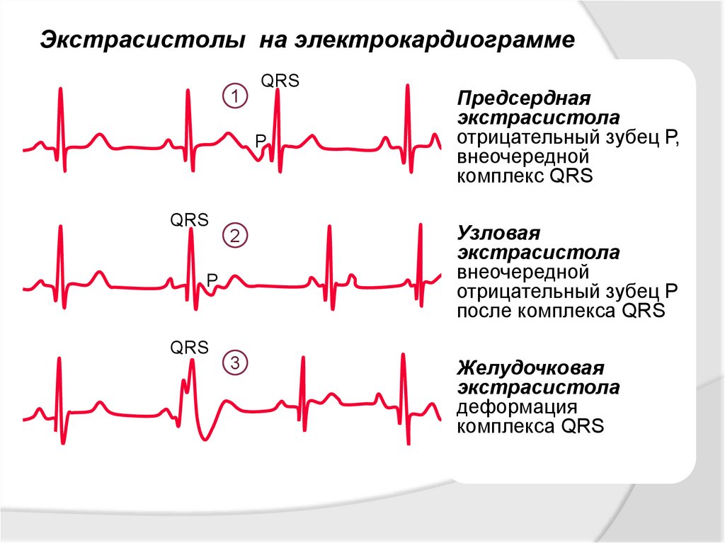 Желудочковая экстрасистолия примеры ЭКГ. ЭКГ монотопные желудочковые экстрасистолы. Единичная желудочковая экстрасистолия на ЭКГ. Нарушения ритма на ЭКГ экстрасистолы. Экстрасистолы лежа