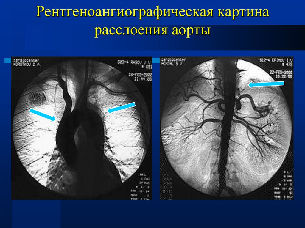 Аневризма аорты у женщин