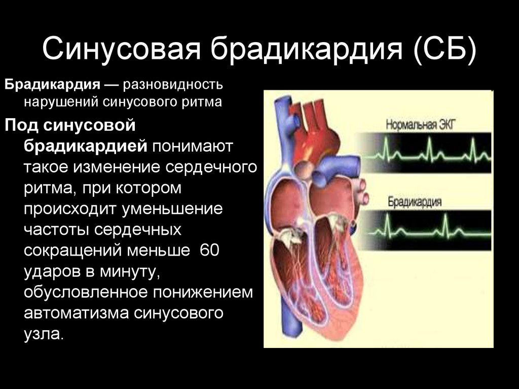 Брадикардия сердца что это такое. Брадикардия сердца что это. Синусовая брадикардия сердца. Нарушение сердечного ритма презентация. Брадикардия с нарушением ритма сердца.