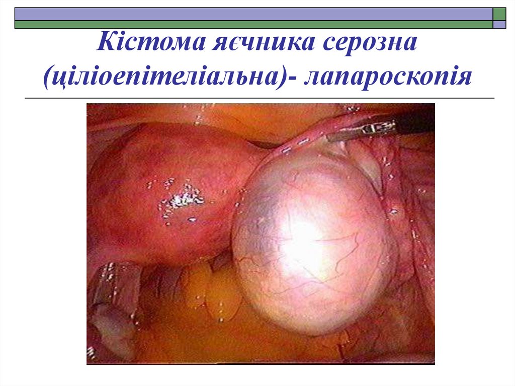 Кістома яєчника серозна (ціліоепітеліальна)- лапароскопія