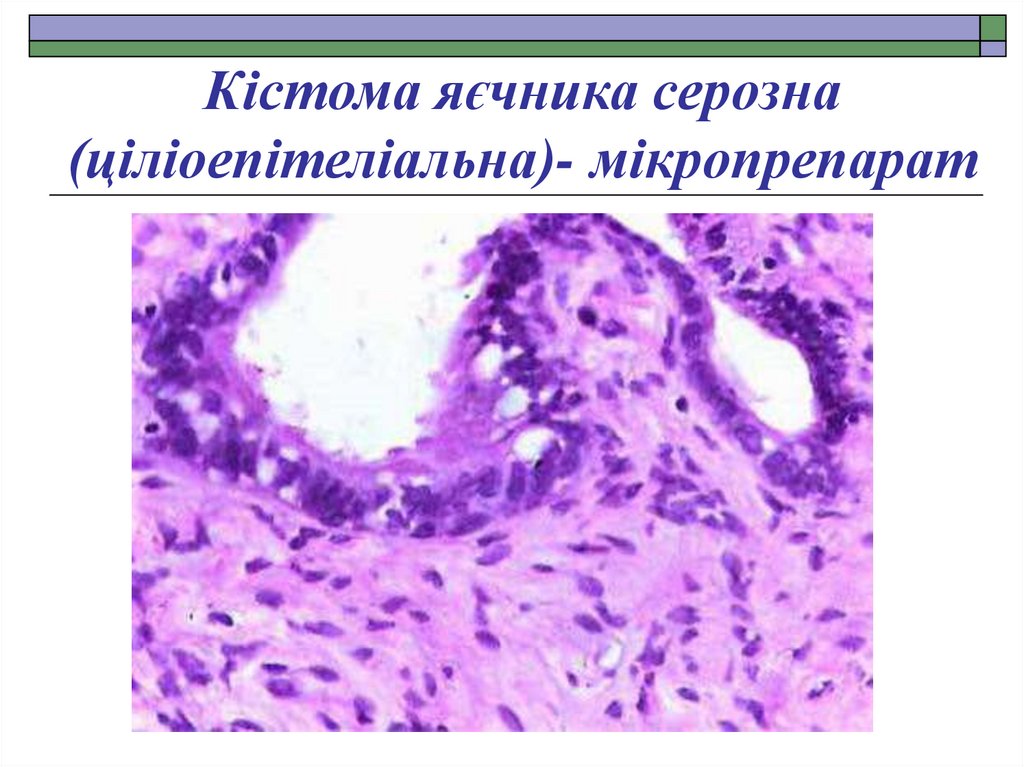 Кістома яєчника серозна (ціліоепітеліальна)- мікропрепарат