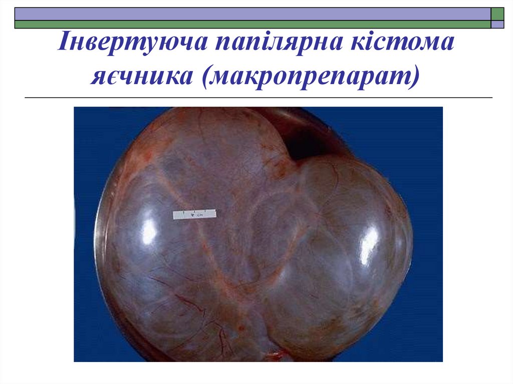 Інвертуюча папілярна кістома яєчника (макропрепарат)