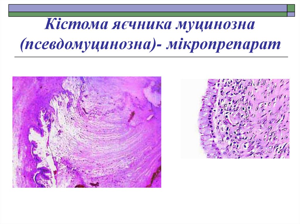 Кістома яєчника муцинозна (псевдомуцинозна)- мікропрепарат