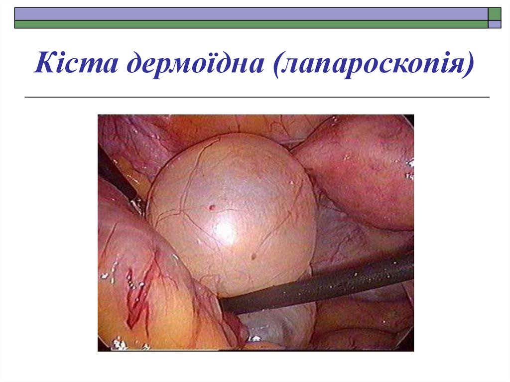 Кіста дермоїдна (лапароскопія)