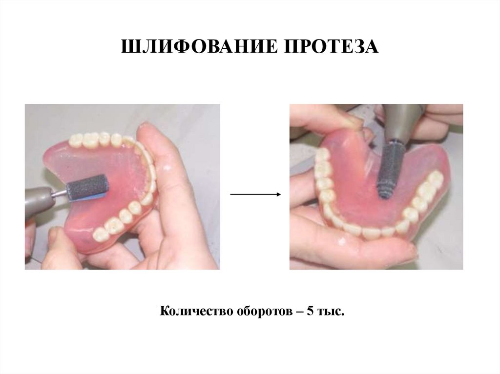 Пластиночный протез этапы. Починка съемных протезов ppt. Виды Починок съемного пластиночного протеза. Починка и коррекция съемных протезов починка съемного протеза.