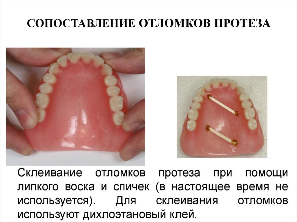 Пластиночные протезы презентация