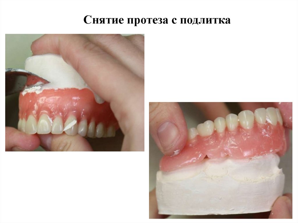 Снятие протеза с подлитка