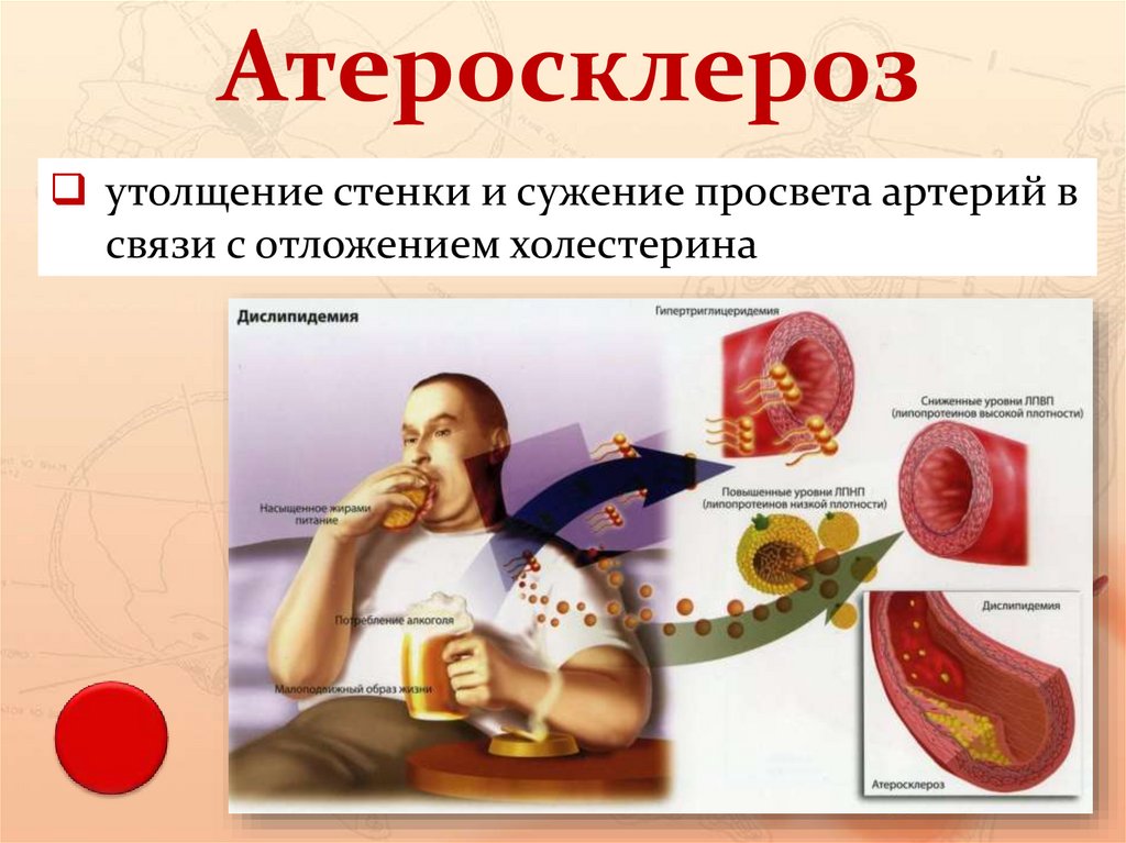 Осложнения атеросклероза. Атеросклеротические изменения сосудов. Причины развития атеросклероза сосудов. Жировые полоски при атеросклерозе. Атеросклеротического поражения стенок кровеносных сосудов.