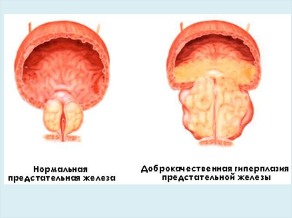 Диффузно узловая гиперплазия железы. Нодозная гиперплазия предстательной железы что это. Аденома предстательной железы и ДГПЖ. Доброкачественная Узловая гиперплазия предстательной железы. Доброкачественная гиперплазия предстательной железы (ДГПЖ).