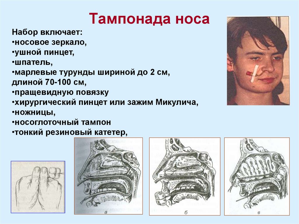 Тампонада носа при носовом кровотечении