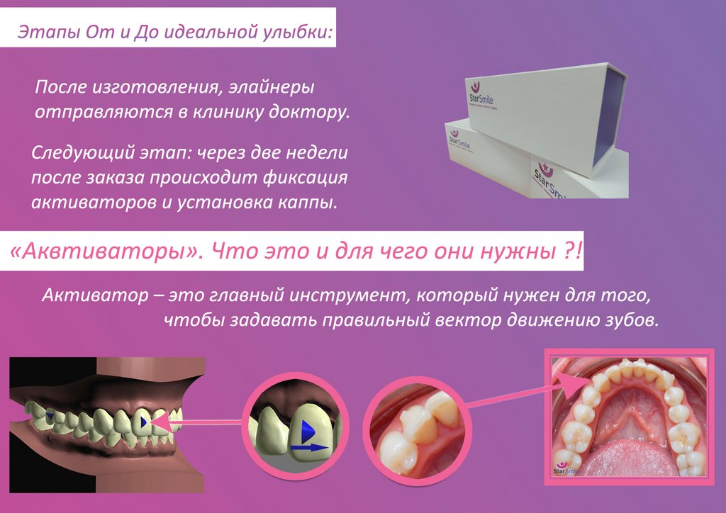 Презентация по брекет системам